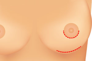 breast-augmentation-diagram