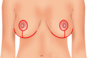 breast-lift-diagram