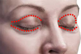 eyelid-lift-diagram