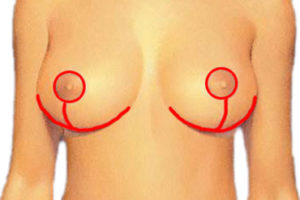 female-breast-reduction-diagram