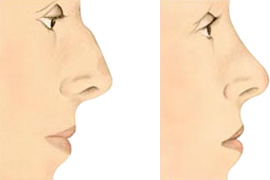 nose-reshaping-diagram